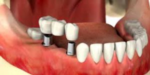 ویژگی ایمپلنت دندانی